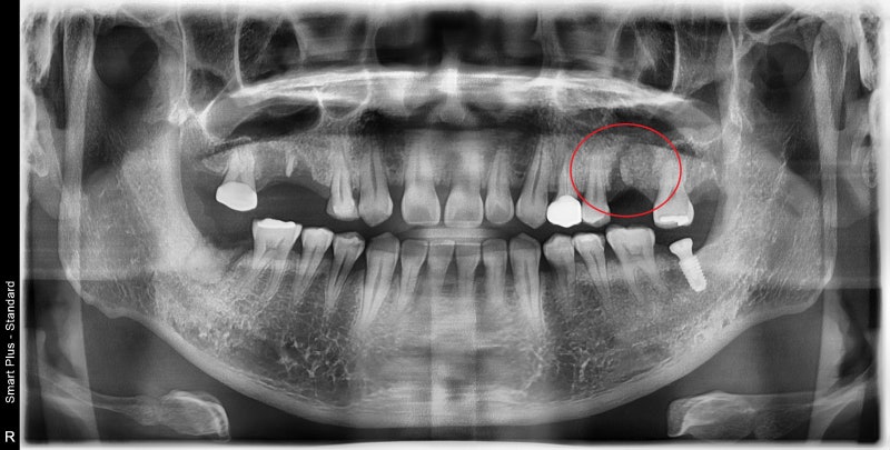 Yaksu Station Dental Clinic: What is the optimal time for implant surgery after extraction? 사진 4