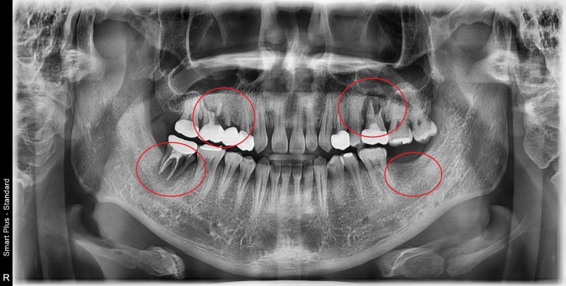 Yaksu Station Dental Clinic: What is the optimal time for implant surgery after extraction?