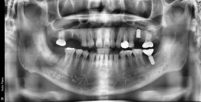 Yaksu Station Dental Clinic: What is the optimal time for implant surgery after extraction? 사진 5