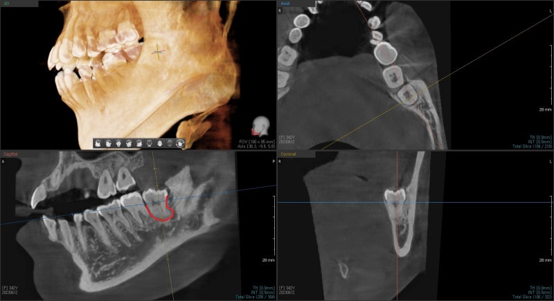 Yaksu Station Dental Clinic, Wisdom Tooth Extraction