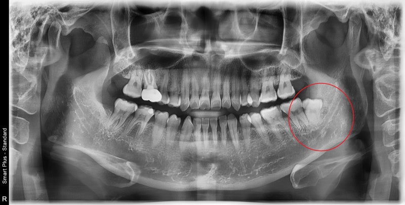 Yaksu Station Dental Clinic, Wisdom Tooth Extraction