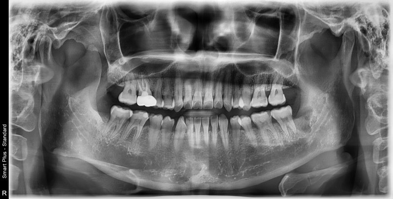 Yaksu Station Dental Clinic, Wisdom Tooth Extraction 사진 4