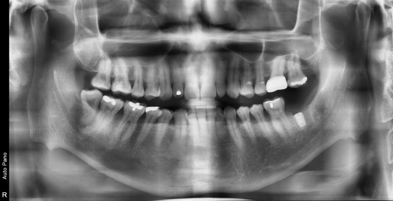 Yaksu-dong Dental Clinic: When a tooth wiggles due to inflammation around the root (Implants, Bone Grafting, Treatment P