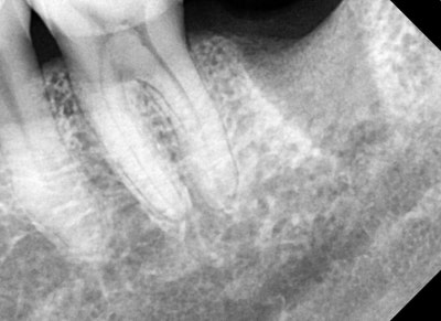 Yaksu-dong Dental Clinic: When a tooth wiggles due to inflammation around the root (Implants, Bone Grafting, Treatment P