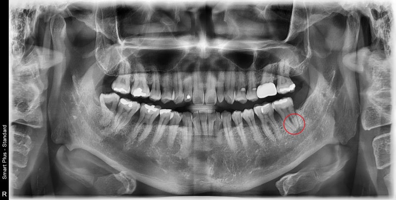 Yaksu-dong Dental Clinic: When a tooth wiggles due to inflammation around the root (Implants, Bone Grafting, Treatment P