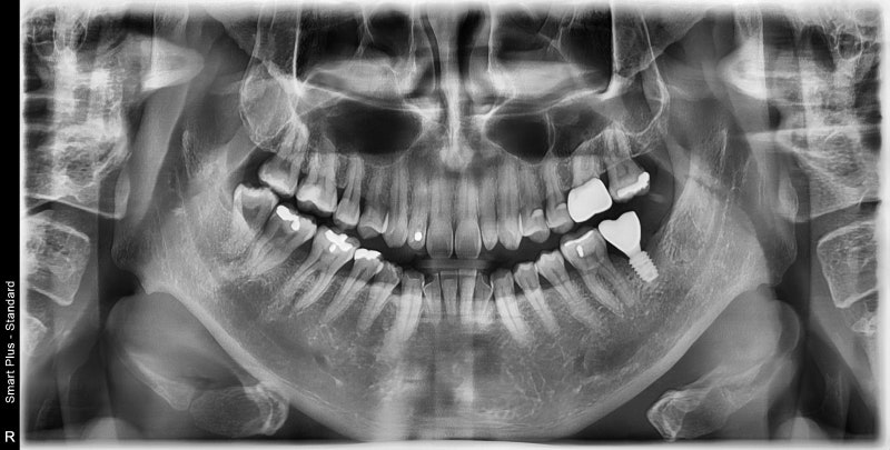 Yaksu-dong Dental Clinic: When a tooth wiggles due to inflammation around the root (Implants, Bone Grafting, Treatment P