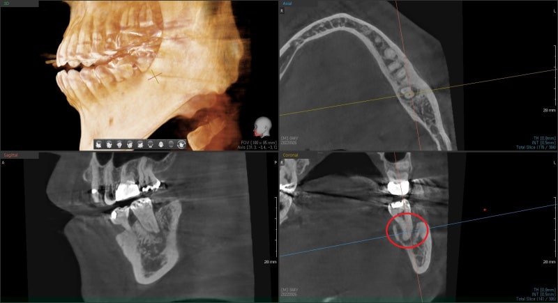 Yaksu-dong Dental Clinic: When a tooth wiggles due to inflammation around the root (Implants, Bone Grafting, Treatment Period)