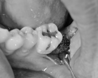 Yaksu-dong Dental Clinic: When a tooth wiggles due to inflammation around the root (Implants, Bone Grafting, Treatment P