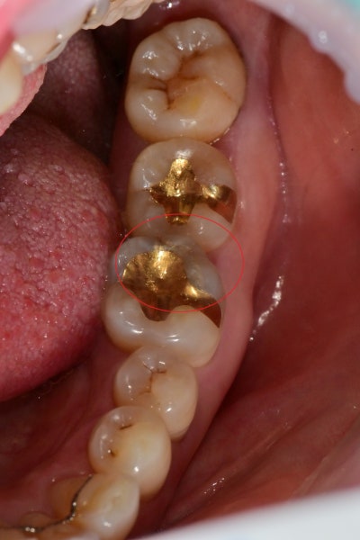 Yaksu-dong Dental Clinic: Treatment for Cracked Teeth (Cracked Tooth) After Removing Old Restorations (MTA, Deep Cavity)