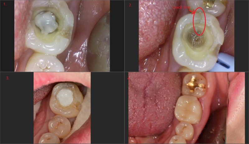 Yaksu-dong Dental Clinic: Treatment for Cracked Teeth (Cracked Tooth) After Removing Old Restorations (MTA, Deep Cavity)