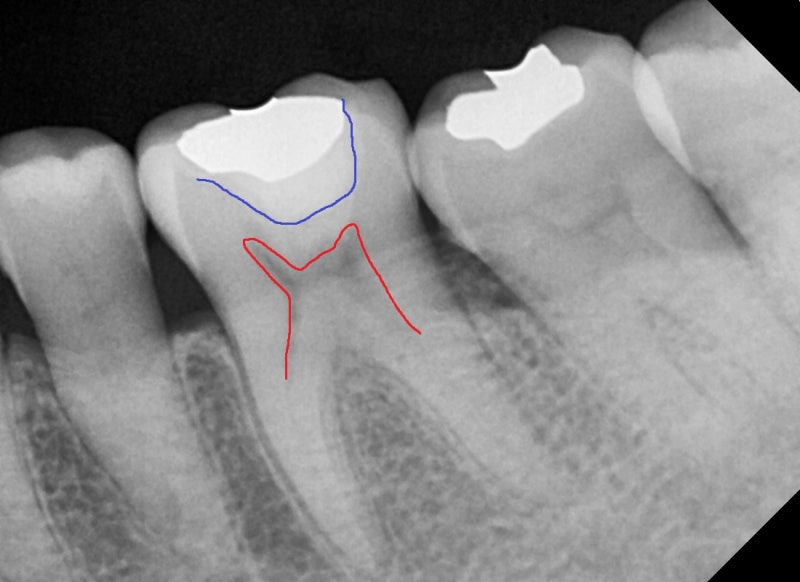Yaksu-dong Dental Clinic: Treatment for Cracked Teeth (Cracked Tooth) After Removing Old Restorations (MTA, Deep Cavity)