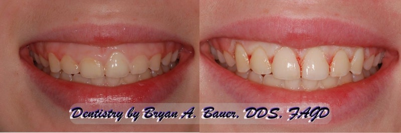 Yaksu-dong Dental Clinic: Straightening Crooked Front Teeth with Crowns After Cavity Treatment 사진 4