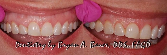 Yaksu-dong Dental Clinic: Straightening Crooked Front Teeth with Crowns After Cavity Treatment 사진 5