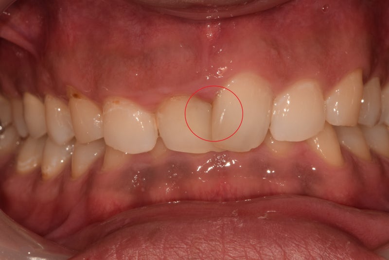 Yaksu-dong Dental Clinic: Straightening Crooked Front Teeth with Crowns After Cavity Treatment