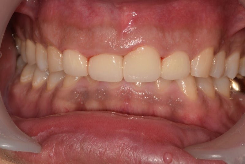 Yaksu-dong Dental Clinic: Straightening Crooked Front Teeth with Crowns After Cavity Treatment 사진 6