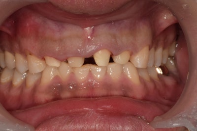 Yaksu-dong Dental Clinic: Straightening Crooked Front Teeth with Crowns After Cavity Treatment