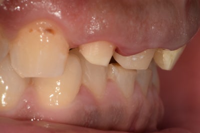Yaksu-dong Dental Clinic: Straightening Crooked Front Teeth with Crowns After Cavity Treatment 사진 3