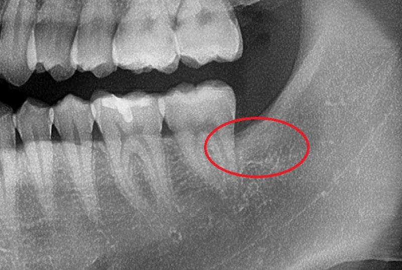 Kumho-dong Dental Clinic: Why Wisdom Teeth Cause Swollen Gums (Pericoronitis Around Impacted Wisdom Teeth) 사진 4