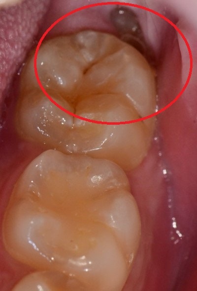 Kumho-dong Dental Clinic: Why Wisdom Teeth Cause Swollen Gums (Pericoronitis Around Impacted Wisdom Teeth) 사진 2