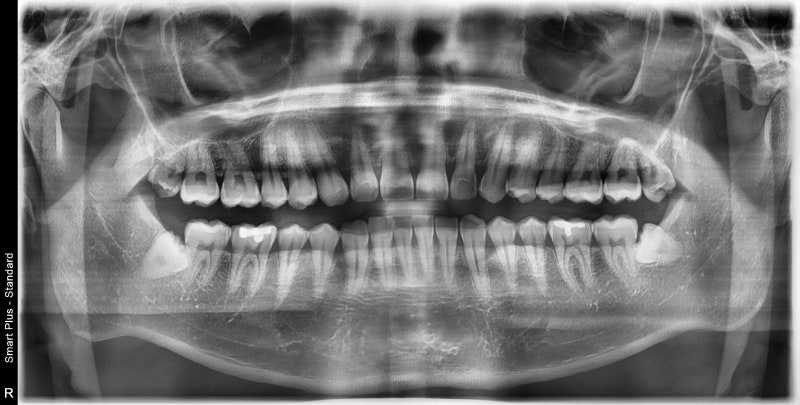 Kumho-dong Dental Clinic: Why Wisdom Teeth Cause Swollen Gums (Pericoronitis Around Impacted Wisdom Teeth)