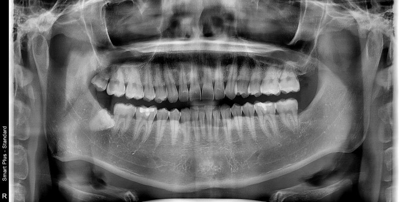Kumho-dong Dental Clinic: Why Wisdom Teeth Cause Swollen Gums (Pericoronitis Around Impacted Wisdom Teeth) 사진 3