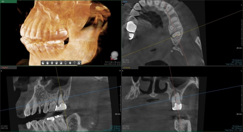 Yaksuyeok Dental Clinic: When Inflammation Occurs Around the Root of a Root-Canal-Treated Tooth, Extraction and Socket Preservation (Treatment for Implant Placement)