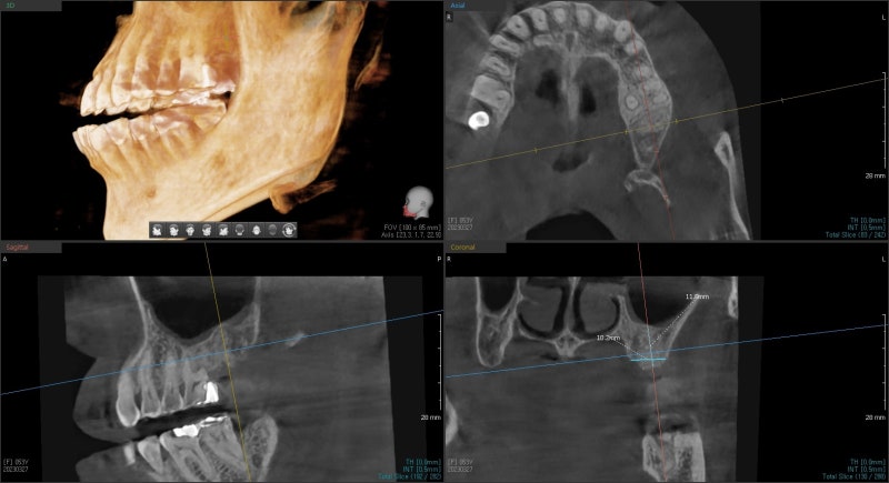 Yaksuyeok Dental Clinic: When Inflammation Occurs Around the Root of a Root-Canal-Treated Tooth, Extraction and Socket P