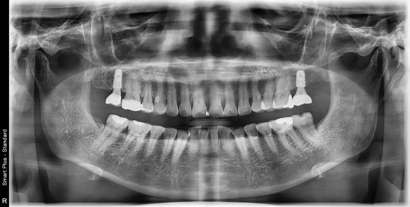 Yaksuyeok Dental Clinic: When Inflammation Occurs Around the Root of a Root-Canal-Treated Tooth, Extraction and Socket P