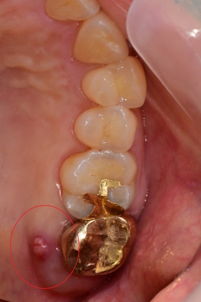 Yaksuyeok Dental Clinic: When Inflammation Occurs Around the Root of a Root-Canal-Treated Tooth, Extraction and Socket P