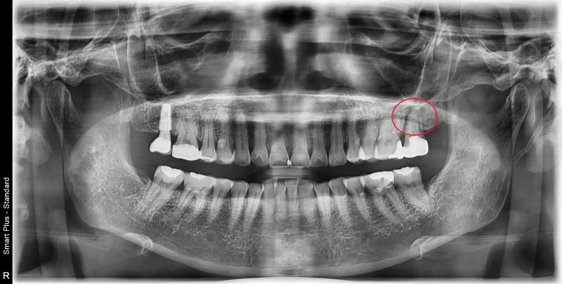 Yaksuyeok Dental Clinic: When Inflammation Occurs Around the Root of a Root-Canal-Treated Tooth, Extraction and Socket P