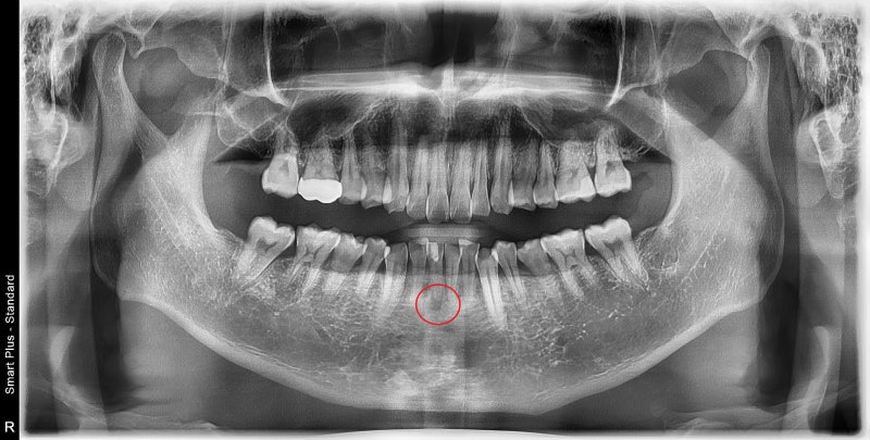Yaksuyeok Dental Clinic: What are the symptoms if root canal treatment is interrupted for a long time after it starts?