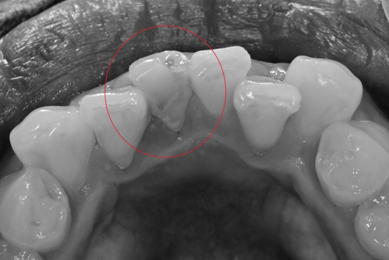 Yaksuyeok Dental Clinic: What are the symptoms if root canal treatment is interrupted for a long time after it starts? 사
