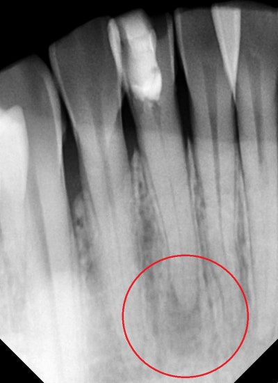 Yaksuyeok Dental Clinic: What are the symptoms if root canal treatment is interrupted for a long time after it starts? 사
