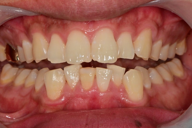 Yaksuyeok Dental Clinic: What are the symptoms if root canal treatment is interrupted for a long time after it starts? 사