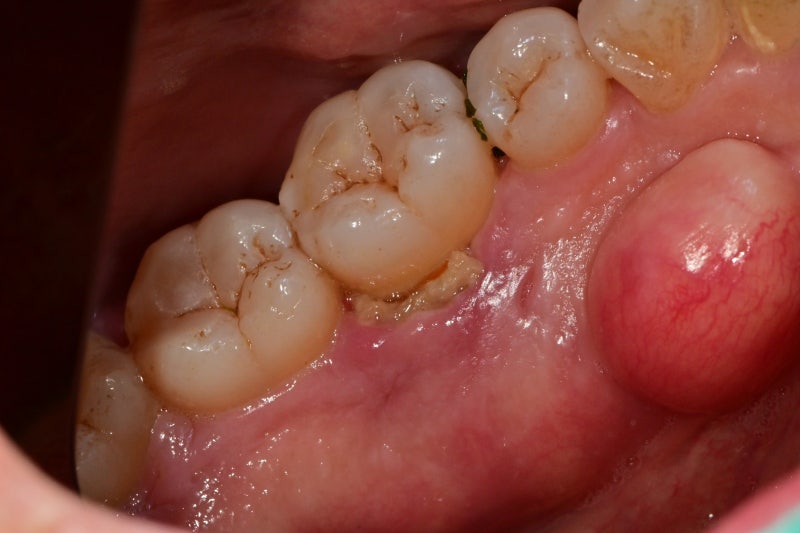Klinik Gigi Yaksu-dong, Mengapa Gusi Selalu Bengkak dan Berdarah pada Gusi dengan Penyakit Periodontal yang Sudah Parah (Menyikat Gigi, Waterpik, Perawatan Gusi)