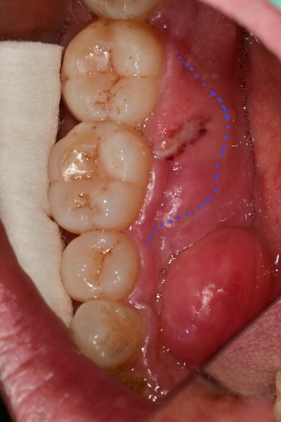 Klinik Gigi Yaksu-dong, Mengapa Gusi Selalu Bengkak dan Berdarah pada Gusi dengan Penyakit Periodontal yang Sudah Parah 