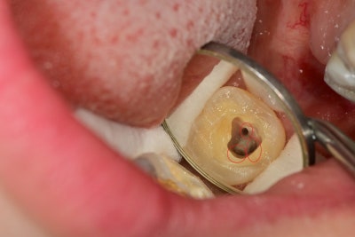 Yaksu Station Dental Clinic: Precautions for Root Canal Treatment of Teeth with Complex Nerve Morphology (C-shaped Canal