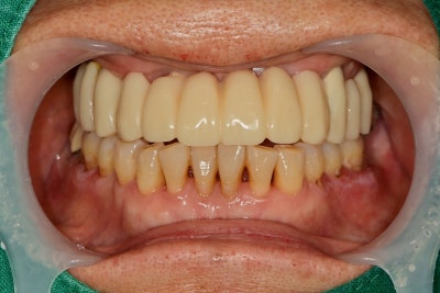 Geumho Station Dental Clinic: The Transition from Full Dentures to Full Implants (The Importance of Selecting the Placem