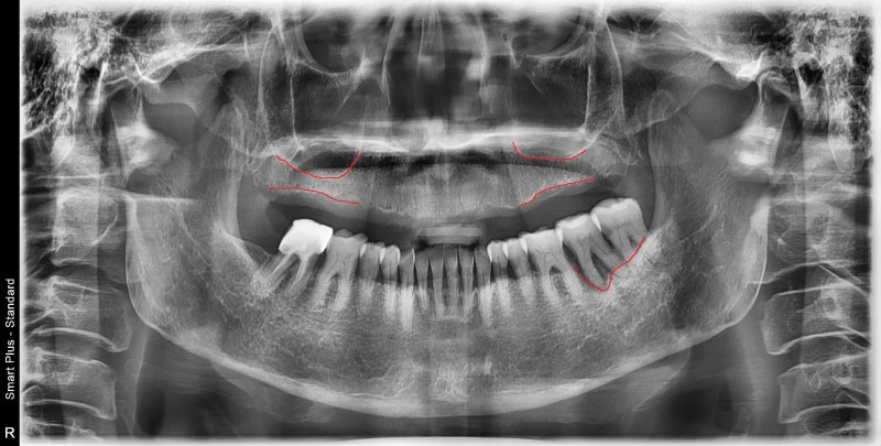 Geumho Station Dental Clinic: The Transition from Full Dentures to Full Implants (The Importance of Selecting the Placem