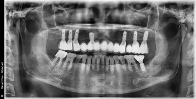 Geumho Station Dental Clinic: The Transition from Full Dentures to Full Implants (The Importance of Selecting the Placem