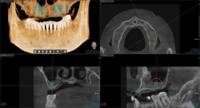 Geumho Station Dental Clinic: The Transition from Full Dentures to Full Implants (The Importance of Selecting the Placement Position)