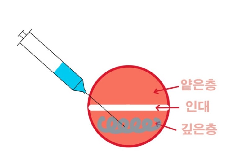 Shindang-dong Dental Clinic: Symptoms That May Appear After Jaw Botox Injections (Square Jaw, Masseter Muscle, 'Candy Ball' Phenomenon)