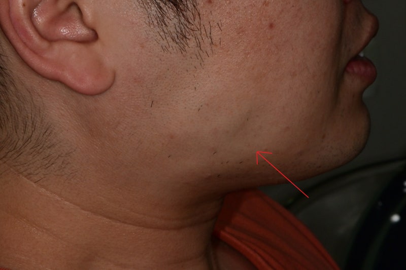 Shindang-dong Dental Clinic: Symptoms That May Appear After Jaw Botox Injections (Square Jaw, Masseter Muscle, 'Candy Ba