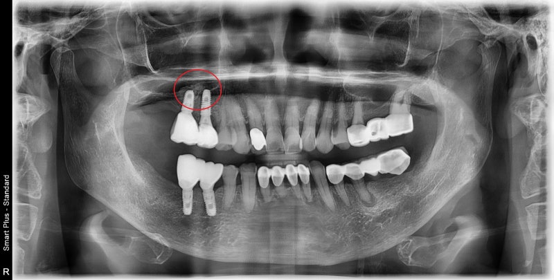 Yaksu Station Dental Clinic: Is an implant always necessary for every missing tooth? (Why implant diagnoses differ) 사진 2