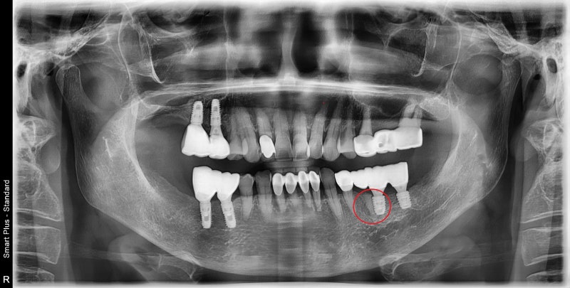 Yaksu Station Dental Clinic: Is an implant always necessary for every missing tooth? (Why implant diagnoses differ) 사진 3