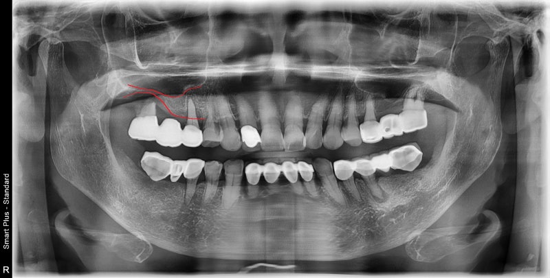 Yaksu Station Dental Clinic: Is an implant always necessary for every missing tooth? (Why implant diagnoses differ)