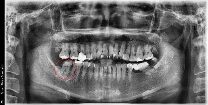 Yaksuyeok Dental Clinic: Is Root Canal Treatment Always Necessary for Cracked Teeth? (Crown Treatment Before Implants, MTA)