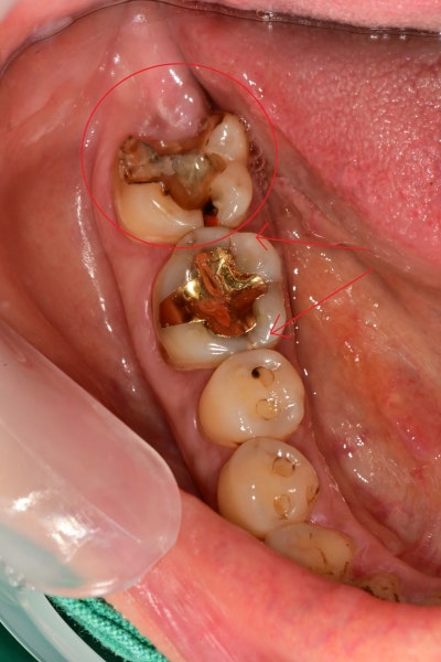 Yaksuyeok Dental Clinic: Is Root Canal Treatment Always Necessary for Cracked Teeth? (Crown Treatment Before Implants, M