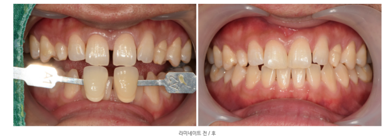 Klinik Gigi Yaksu, Hal-hal yang Perlu Diperhatikan Saat Membuat Ulang Restorasi Estetika Gigi Anterior (Apakah Laminate 