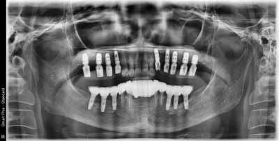 Shindang Implant: Should I get one or not? (Advanced Bone Graft Implant Duration and Pain) 사진 11